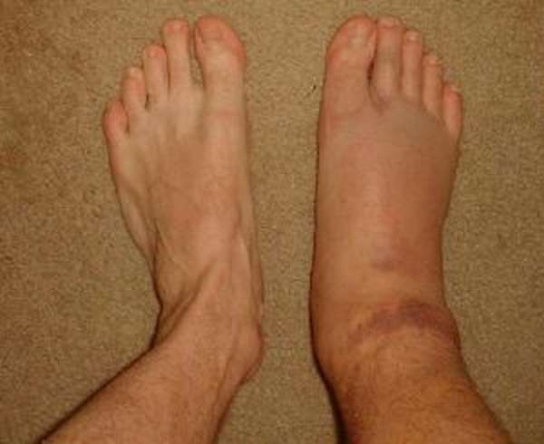 Отек ноги после перелома голеностопа